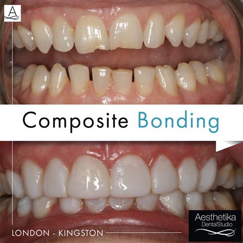 what are composite teeth.